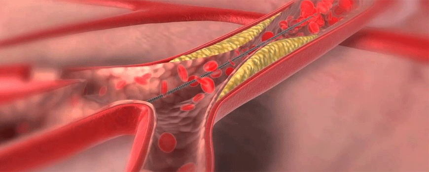 Implantacija stenta nekoliko dana od otvaranja infarktne arterije