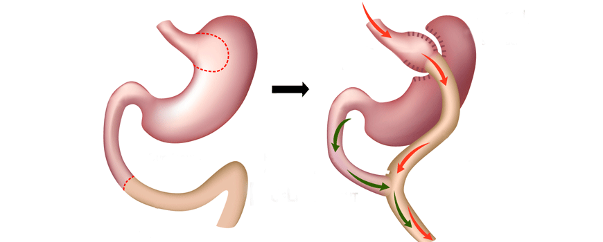 By-pass želuca kao terapija DM tip 2 kod gojaznih
