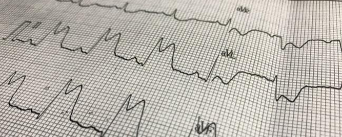 Femoralni vs. radijalni PCI pristup: SAFARI-STEMI studija