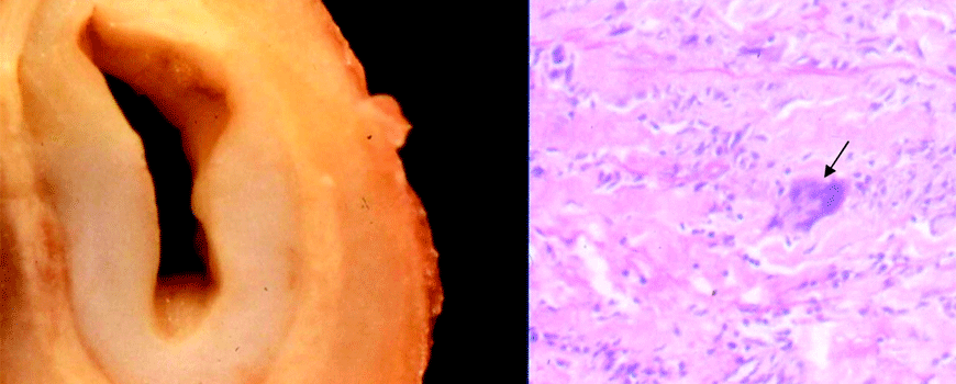 Takayasu arteritis – prediktori ishoda i komplikacija