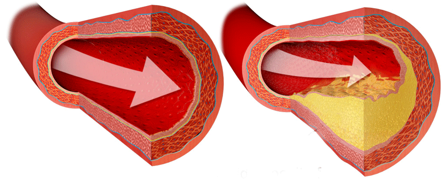 Post-IM angina: opstruktivna vs. neopstruktivna koronarna bolest