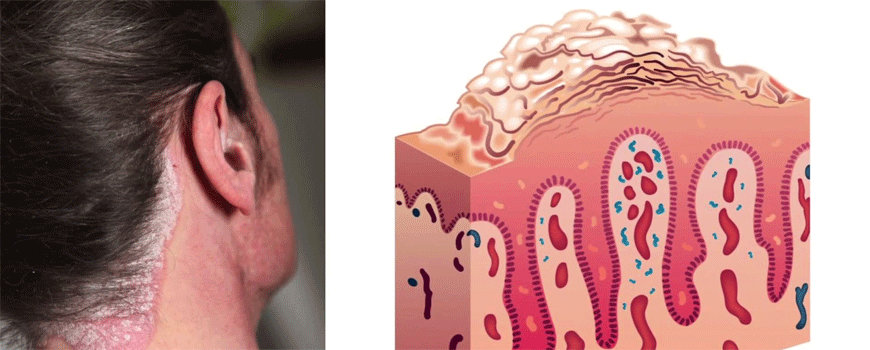 Psorijaza i ateroskleroza koronarnih arterija