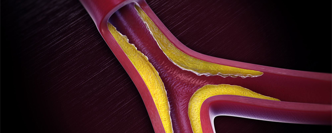 Usporiti progresiju ateroskleroze ACE inhibitorom