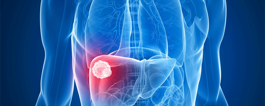 Nova terapijska opcija ranog hepatocelularnog karcinoma