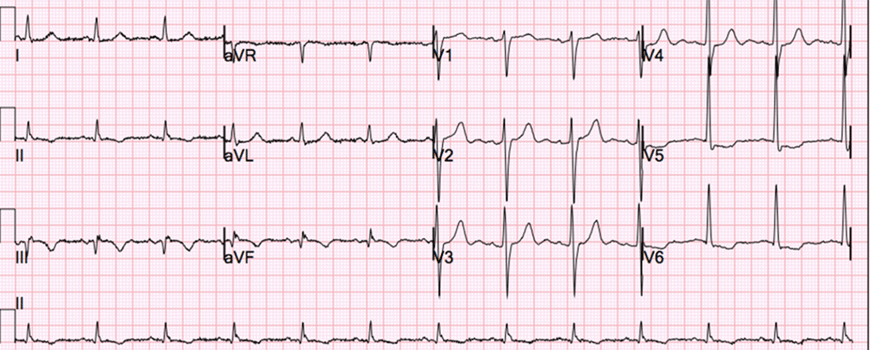 NSTEMI i kompletna okluzija infarktne arterije