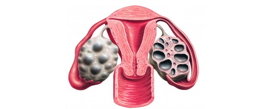 Metformin kod adolescetnjika sa PCOS