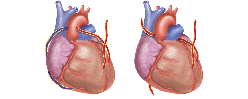 Pacijenti bez dijabetesa sa višesudovnom koronarnom bolešću: PCI ili CABG?