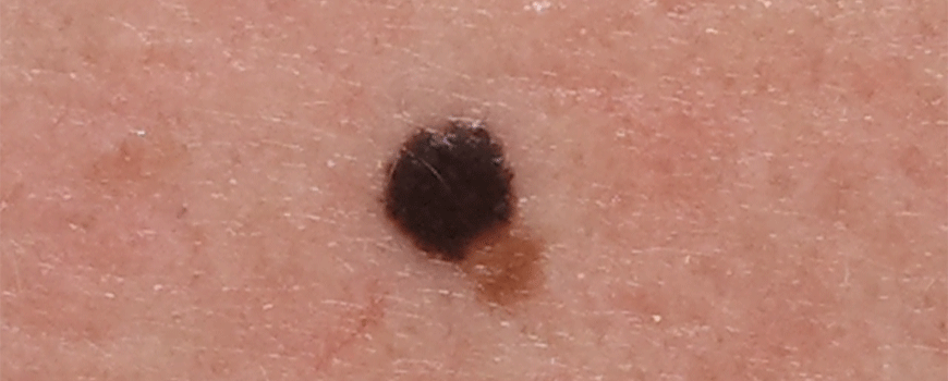 Onkolitički virus u terapiji melanoma