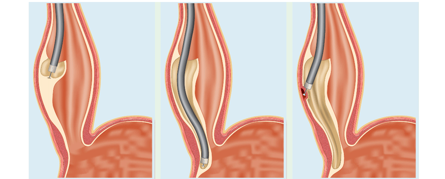 Lečenje gastropareze endoskopskom miotomijom