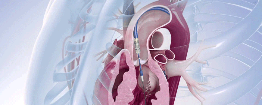 SURTAVI: TAVI vs. hirurgija