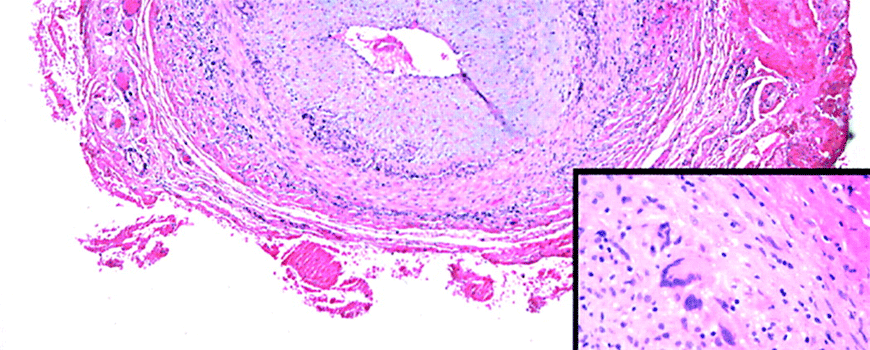 Tocilizumab kod temporalnog arteritisa