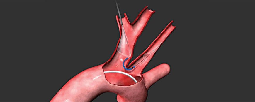 Prevencija cerebralnih embolusa tokom TAVR