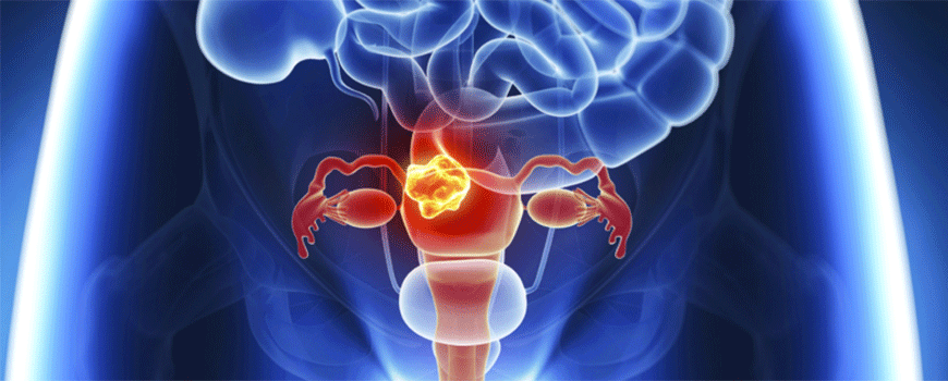 Rani karcinom endometrijuma – laparoskopsko ili hirurško uklanjanje?