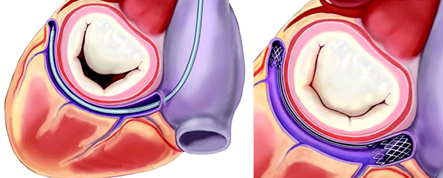 Perkutana anuloplastika mitralne valvule kod srčane insuficijencije