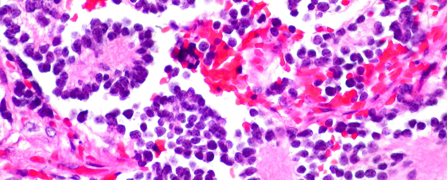 Odobrena nova terapija neuroblastoma kod dece