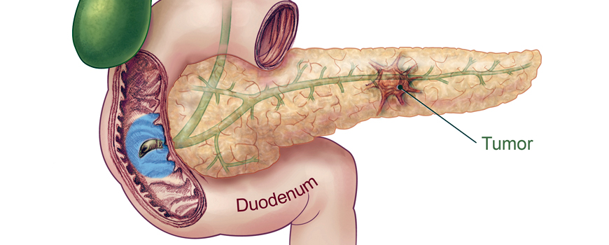 Lanreotid – novi lek za neuroendokrine tumore