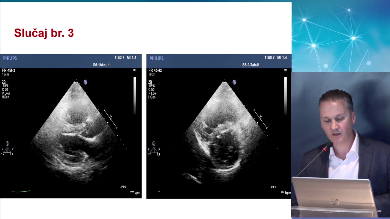 PKR 2018 - PERKUTANE INTERVENCIJE NA PLUĆNIM ARTERIJAMA - PRIKAZI SLUČAJEVA