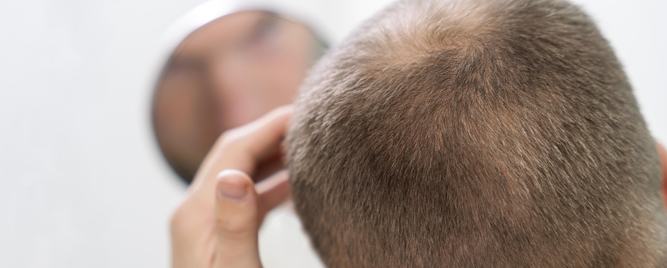 Novodijagnostikovana alopecia areata – prati je rizik od određenih komorbiditeta