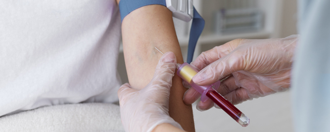 Postoperativni tok pacijenata ako su koristili SGLT2 inhibitore