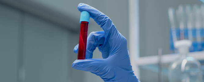 Lečenje postoperativne anemije kada pacijenti imaju veći rizik od srčanih komplikacija