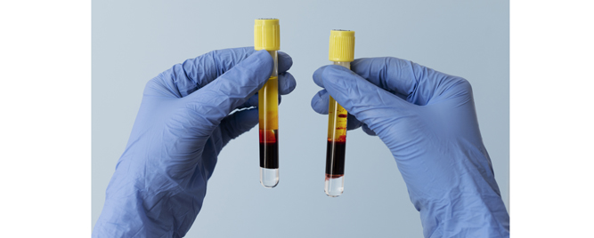 Evolokumab za pacijente koji nisu preležali IM ili moždani udar