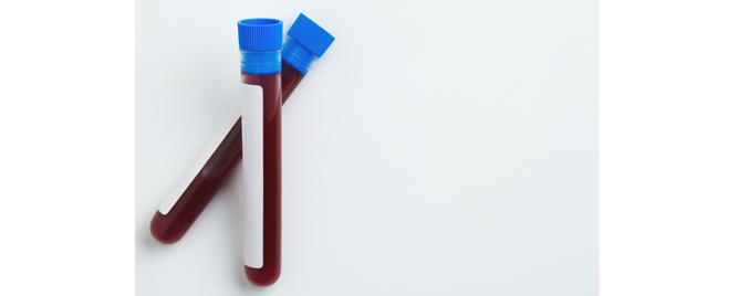 Hirurško ili medikamentno lečenje obostranih adrenalnih tumora: mortalitet, KV rizik i kontrola bolesti