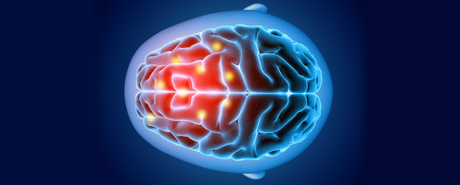 Nove američke preporuke za lečenje akutnog ishemijskog moždanog udara