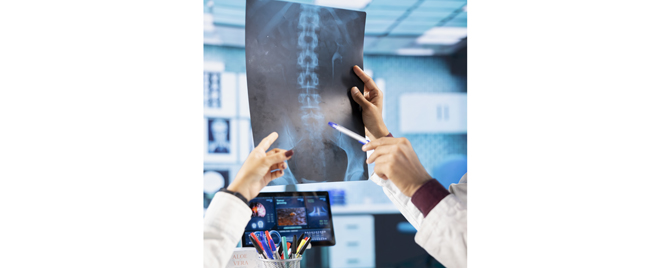 Novi pristup u lečenju osteoporoze: kraća terapija romosozumabom jednako uspešna