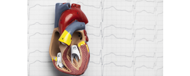 AF i nedavni moždani udar: antikoagulans sa/bez kateterske ablacije?