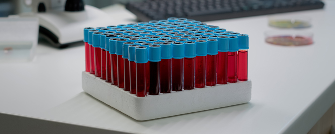 Primarni aldosteronizam povećava rizik od AF i moždanog udara